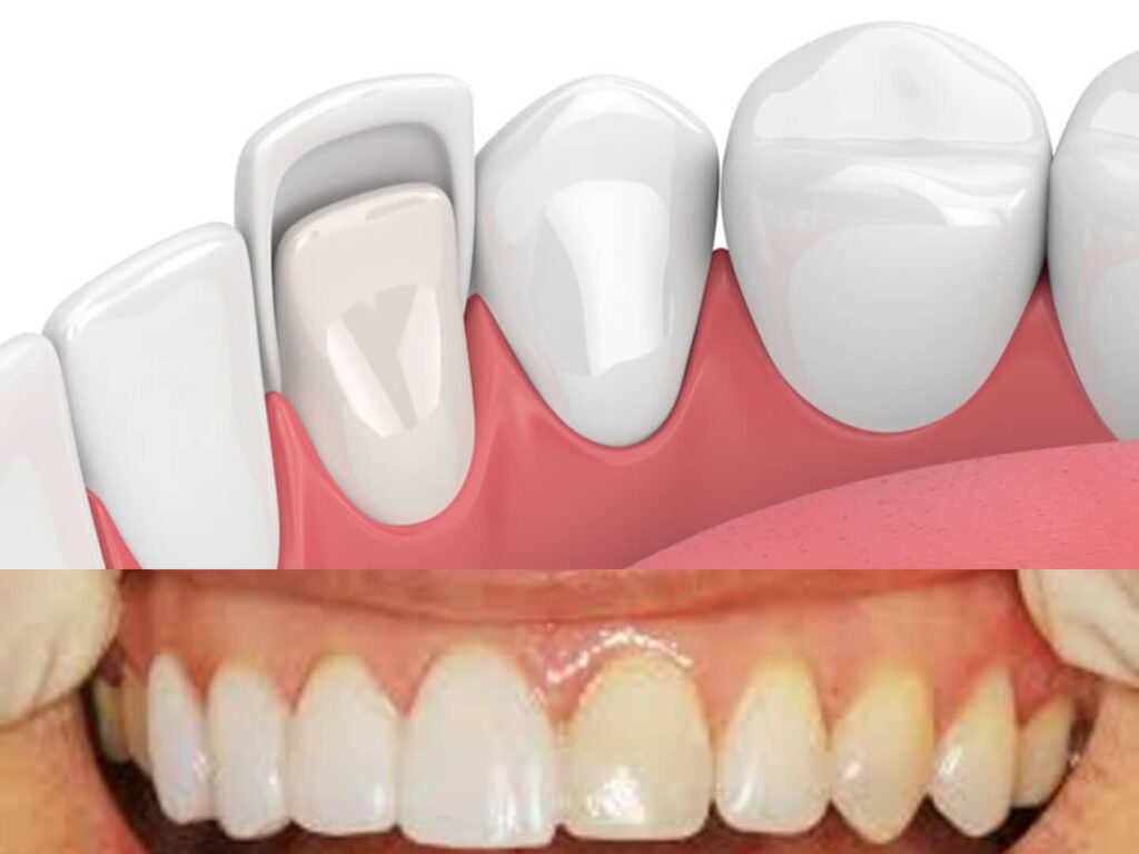 Veneers