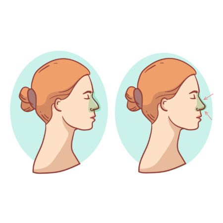 Die verborgenen Nachteile der Rhinoplastik