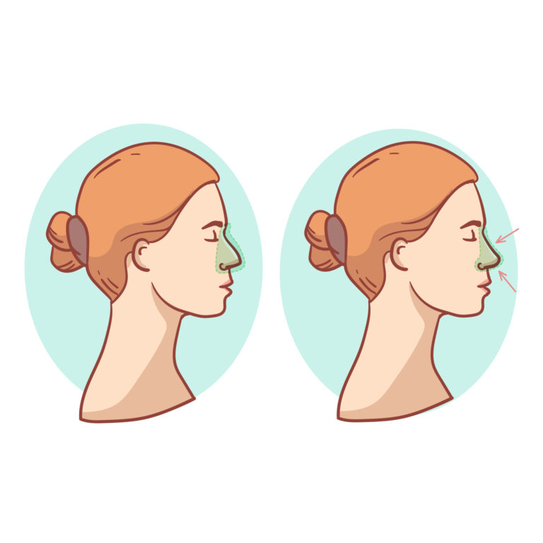 Die verborgenen Nachteile der Rhinoplastik