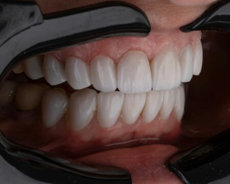 Veneers