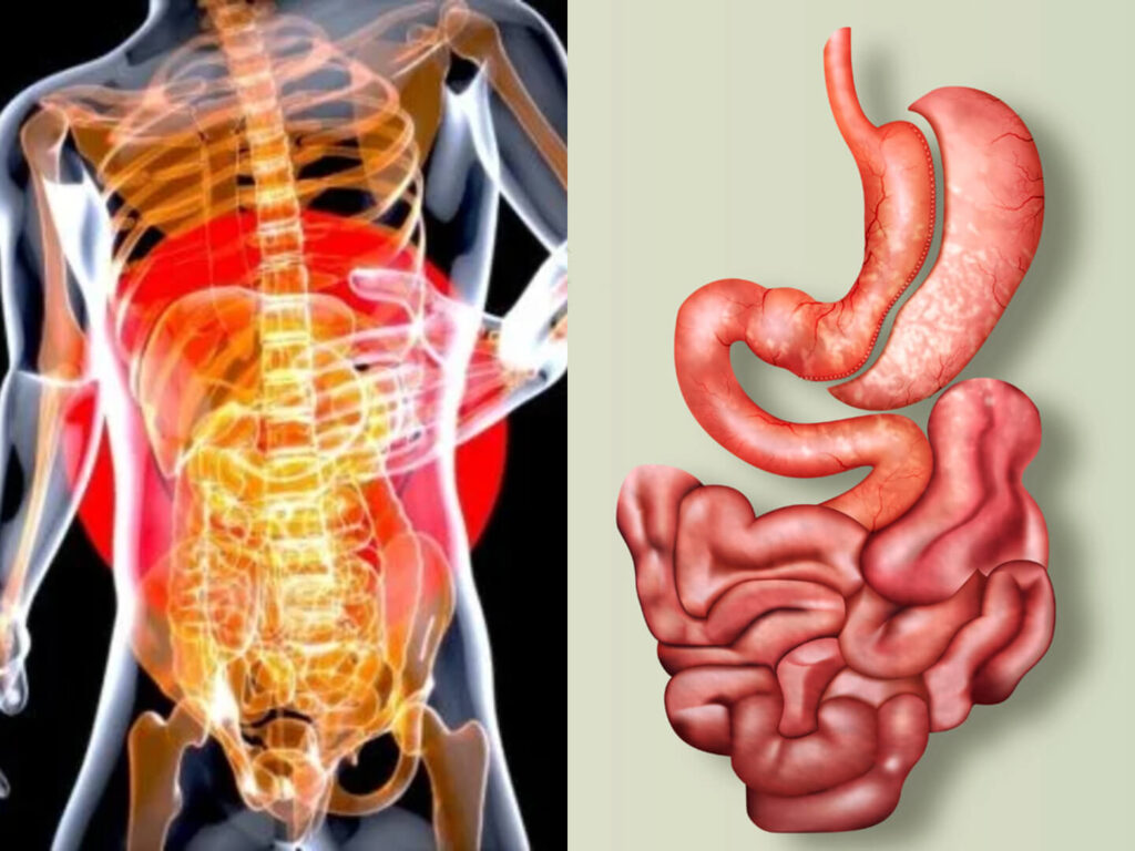 nach einer Schlauchmagen-OP